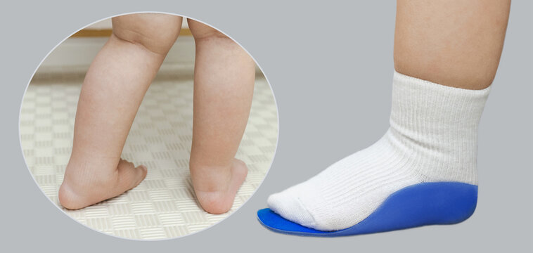 Medical collage showing kid legs valgus curvature and orthotic arch support insert. Podiatry exam and pediatric foot correction strategy.