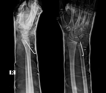 AP and lateral wrist radiograph demonstrating distal radius Kirschner wire fixation inside plaster cast