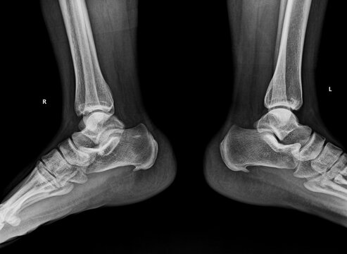 Bilateral lateral ankle X-ray displaying prominent calcaneal spurs and plantar fascia attachment points