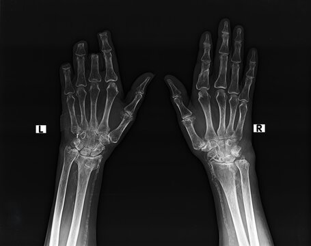 Bilateral hand PA X-ray showing left distal finger amputations and bilateral vascular calcification