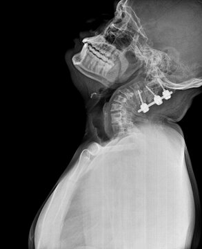Lateral cervical spine X-ray demonstrating posterior occipitocervical fusion construct with pedicle screws and rods