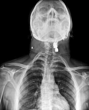 AP cervical spine X-ray showing occipitocervical surgical hardware and upper thoracic cage
