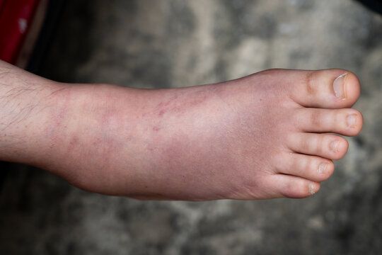 Swollen Foot After Cast Removal of Metatarsal Fracture