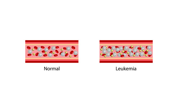 Leukemia, blood cancer. Erythrocytes, platelets and lymphocytes. Vector illustration.