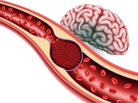 Ischemic Stroke Caused by Blood Clot Blocking a Brain Artery with Reduced Blood Flow, Cerebral Thrombosis and Human Brain Medical Illustration