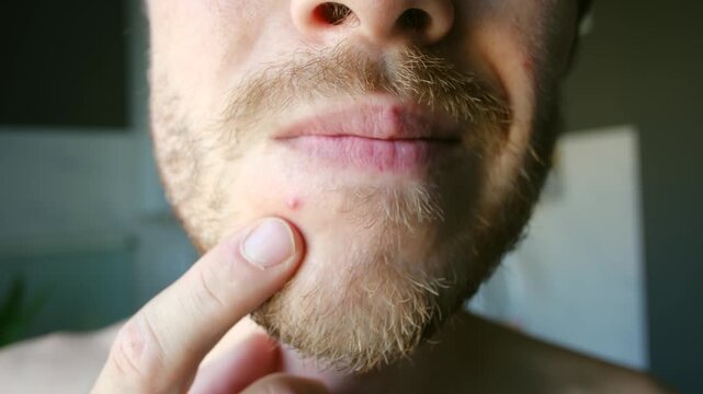 Bearded man touching red pimple on chin with finger, common skin problem and concept of acne, skin imperfections, personal grooming in detailed close up. Close up of man touching pimple on his chin