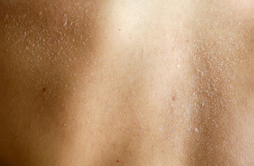 Fototapeta premium A close-up view of dry, peeling skin on a person woman back, illustrating dermatology, skin dehydration, peeling after sunburn, and health care