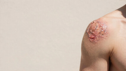 Fototapeta premium Close-up of a shoulder injury with inflamed, scabby skin and visible damage