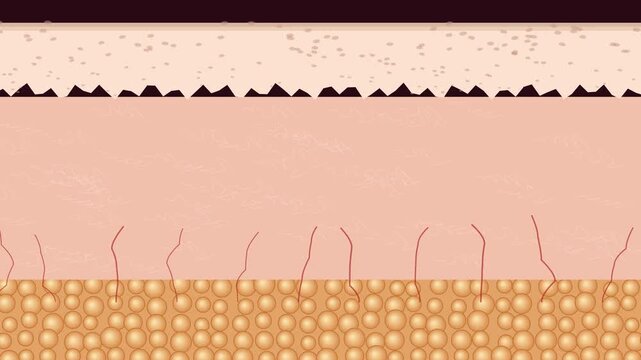 3D animation of dermatitis eczema skin condition showing cracking of the stratum corneum and inflammation with immune cells rushing to the damaged skin barrier