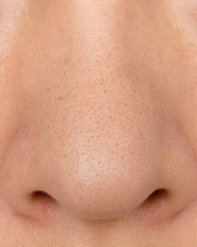 Front view close-up of nose with blackheads and enlarged pores