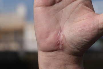 Fototapeta premium Carpal tunnel surgical scar four weeks post op