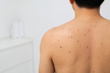 Naklejka premium Multiple Cutaneous Neurofibromas on Upper Back in Neurofibromatosis Type 1