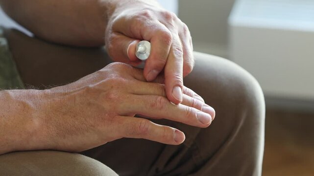 Man using curative topical cream or ointment  to affected fingers to help from dermatitis, dry patches or psoriasis discomfort. Home skin care medical treatment concept.