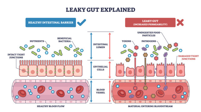 Leaky gut syndrome shown, epithelial cells, tight junctions, and a blood vessel compare healthy barrier vs increased permeability letting toxins enter the bloodstream, transparent background