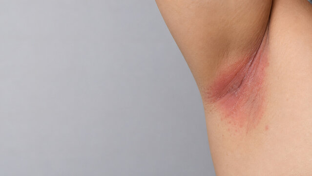 Axillary Intertrigo with Satellite Papules and Copy Space Close Up