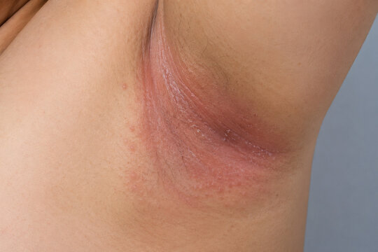 Axillary Intertrigo with Erythema and Scaling in Skin Fold Close Up