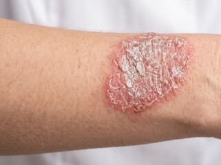 Fototapeta premium Close-up of psoriasis on arm showing red, scaly skin for World Psoriasis Day 