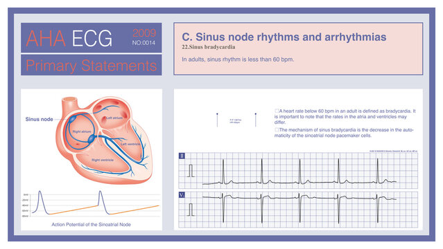 When the pacemaker cells of the sinoatrial node fire impulses at a slower rate, below 60 beats per minute, an electrocardiogram will record sinus bradycardia.

