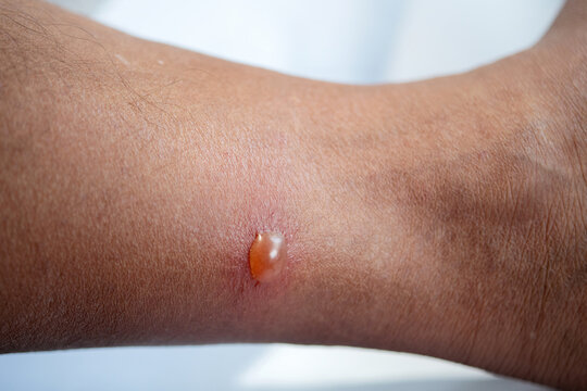 Close up. Blisters caused by insect bites, particularly sandfly bites, on a man's leg resulted in an allergic reaction..