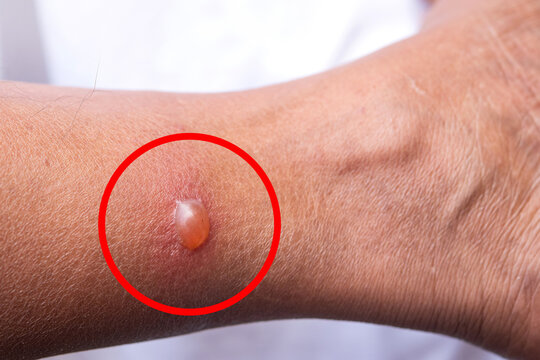 Close up. Blisters caused by insect bites, particularly sandfly bites, on a man's leg resulted in an allergic reaction. red graphic shows position of blister