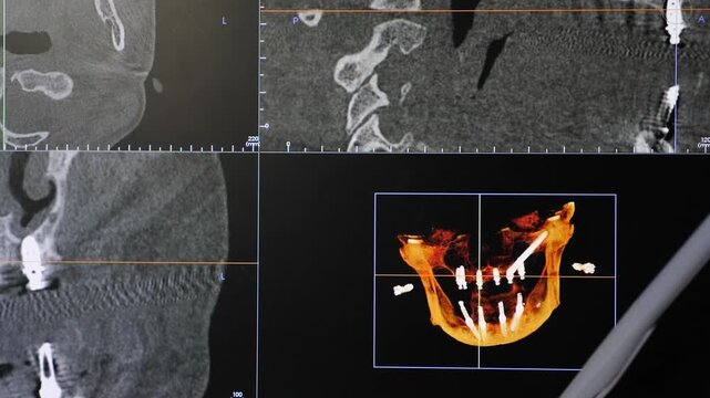 Dental CT scan monitor showing four-panel interface. 3D jaw model with orange and yellow bone structure, gray cross-sections, and virtual implant planning. Stomatology diagnostics 4k video