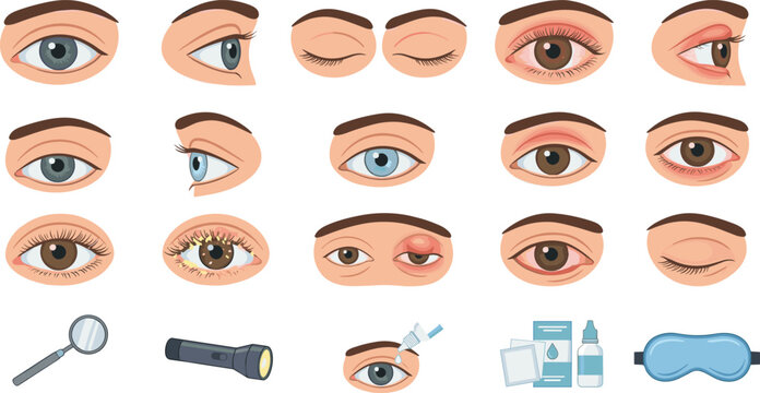 Medical Vector Icon Set Illustrating Diverse Eye Angles Blepharitis Eyelid Inflammation Swelling Chalazion Symptoms and Ophthalmology Clinical Treatment Care Products