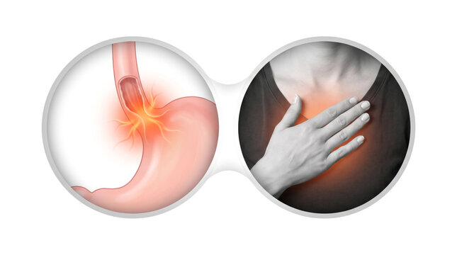 GERD Acid Reflux Heartburn Gastroesophageal Reflux, Medical illustration showing stomach acid flowing into esophagus causing burning chest pain