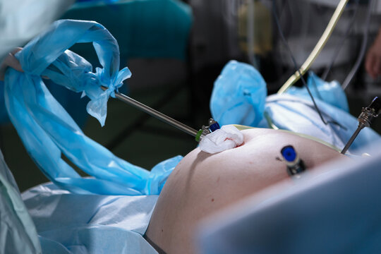 Actual process of laparoscopic (minimally invasive) surgery. Laparoscopic surgery process: surgical team performs minimally invasive procedure in operating room