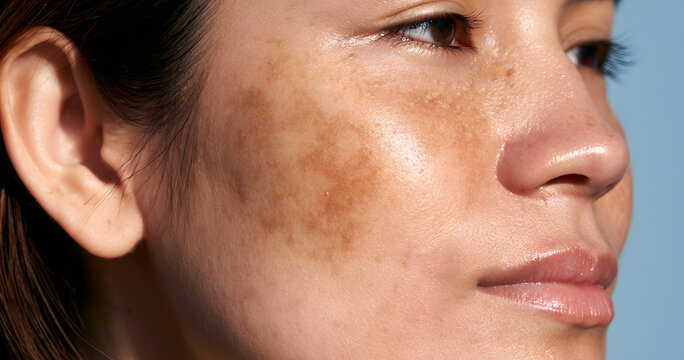With facial melasma and hyperpigmentation and a natural skin texture, the focus is on skincare, dermatology, beauty, and beauty awareness.