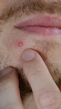 Close up young bearded man trying to pop pustule near his mouth, dealing with acne vulgaris skin problems and highlighting need for dermatological care and proper hygiene. Man squeezing pimple on face