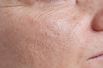 Fototapeta premium Dry facial skin with visible flakes and fine wrinkles on cheek close up, textured porous skin, natural complexion, slight redness, detailed macro skin surface