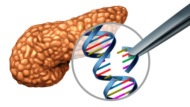 Diabetes genetics concept showing misfolded insulin in pancreatic beta cells causing cellular stress and reduced insulin production as a medical research illustration of genetic disease mechanisms and