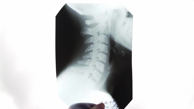 Medical specialist places a cervical spine X-ray onto an illuminated viewing board before examination. Professional radiology workflow in a healthcare environment focused on diagnostic imaging.
