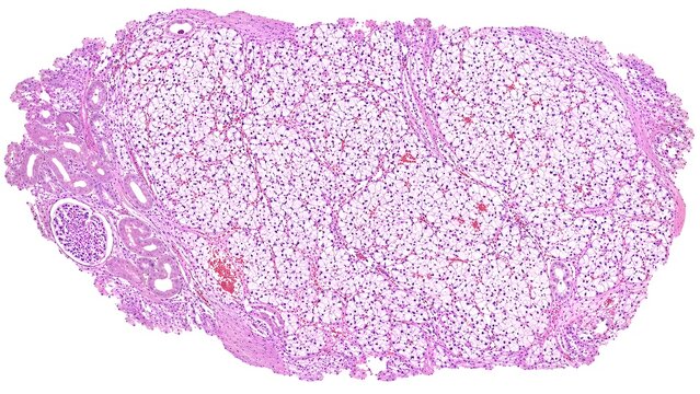 Clear Cell Renal Cell Carcinoma Histopathology H&E Microscopy Atlas