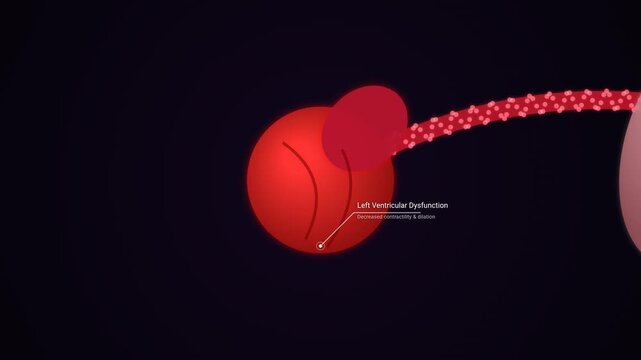 Medical animation explaining the progression of cardiogenic pulmonary edema from left ventricular dysfunction to severe cellular hypoxia and systemic failure