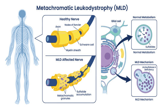 Detailed Metachromatic leukodystrophy infographic presenting genetic inheritance, nervous system damage, symptoms, diagnosis, and modern treatment approaches.