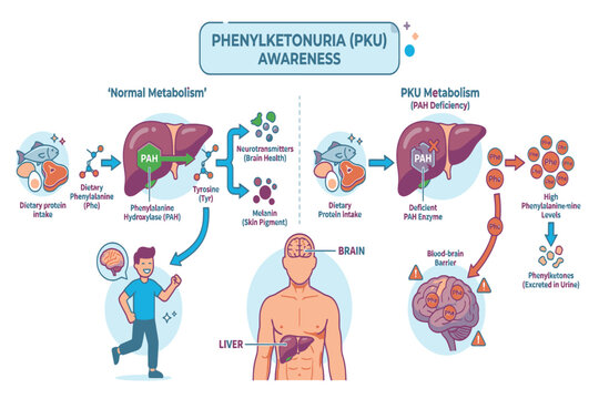 Professional medical infographic presenting Phenylketonuria pathology, enzyme deficiency, clinical symptoms, newborn diagnosis, and nutritional management.
