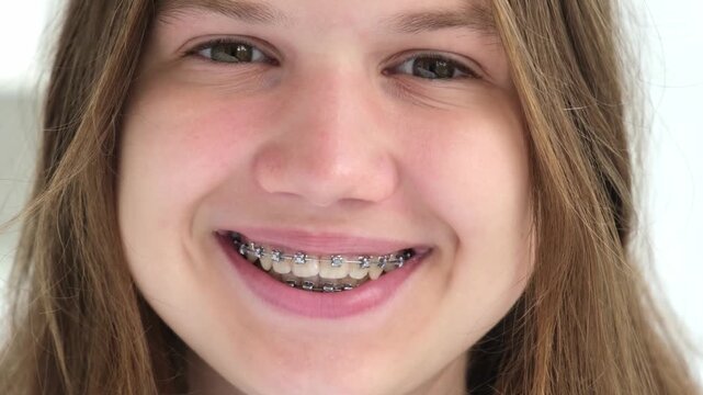 Close up face of happy positive joyful caucasian girl smiling showing teeth with dental braces. Happy teen with brackets looking at camera