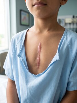 Healed Keloid Sternotomy Scar After Pediatric Heart Surgery Follow Up Examination