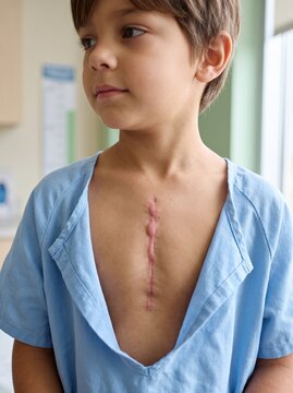 Healed Keloid Sternotomy Scar After Pediatric Heart Surgery Follow Up Examination