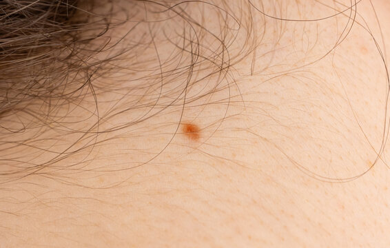 Skin mole closeup. Macro photo of blemish similar to melanoma