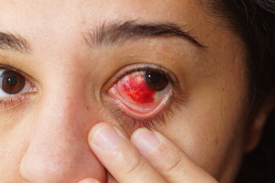 Close-up of an ethnic young woman's eye with a subconjunctival hemorrhage and broken blood vessel