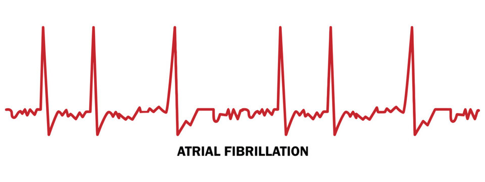 Medical illustration of atrial fibrillation heart rhythm on a clean white background display.