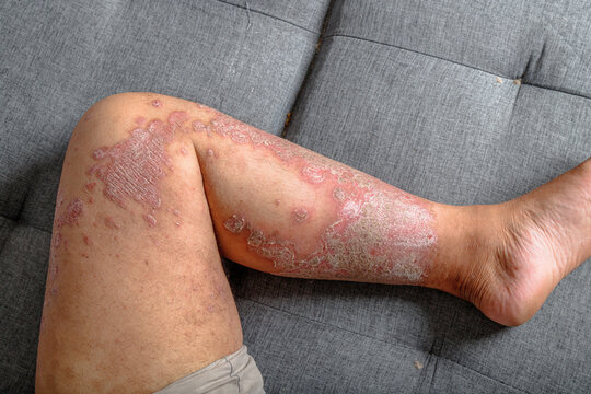 Close-up of inflamed dry scaly skin on a human leg, A chronic skin condition with redness, irritation, and flaky texture for healthcare and dermatology