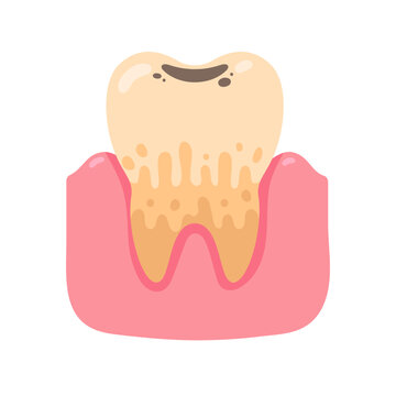 Unhealthy tooth illustration with visible plaque, tartar, a deep cavity, and inflamed gums indicating dental disease