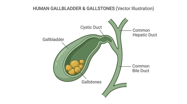 Human gallbladder anatomy vector illustration featuring yellow gallstones within a clinical medical diagram for educational study
