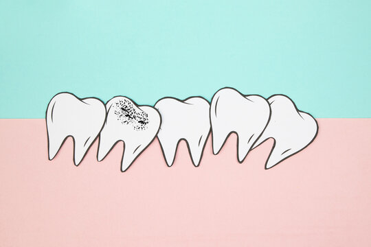 Crooked teeth row, caries, inflammation or acute pain, toothache, cavity tooth issue, dental extraction, bacterial periodontitis