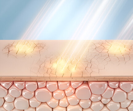 human skin cell layers cracking and breaking down under ultraviolet UV light attack. Visualization of sun damage, skin barrier destruction, and premature aging concept, 3D illustration.