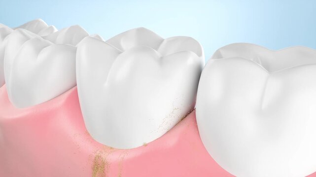 Close-up of a dental cleaning showing the removal of plaque at the gum line, This image highlights the process of removing plaque and food particles. 3d rendering.
