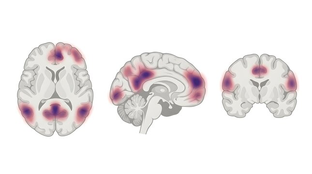 Human brain scan showing neural activity regions